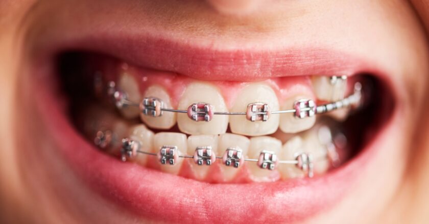 orthodontics Treatment: Improving Your Smile, Health, and Quality of Life